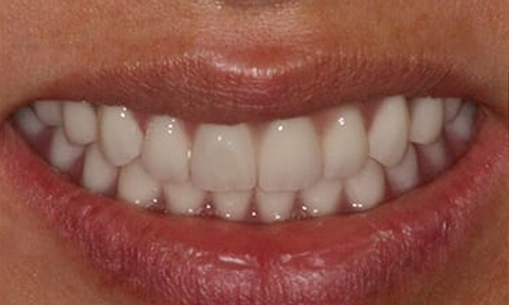 Full Mouth Reconstruction Patient 1 After