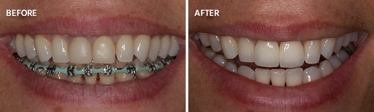 Before and After Full Mouth Reconstruction Patient 6