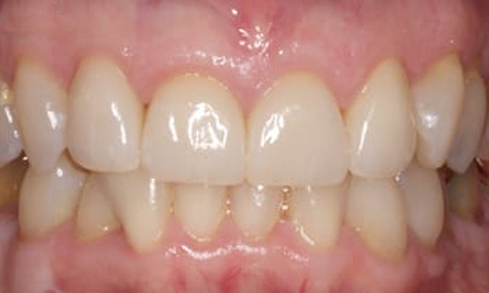 Dental Crowns Patient 1 After