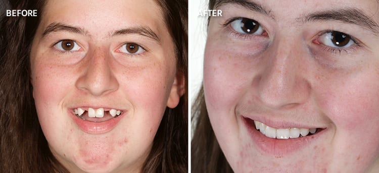 Before and After Close Up of Patient 3 Full Face