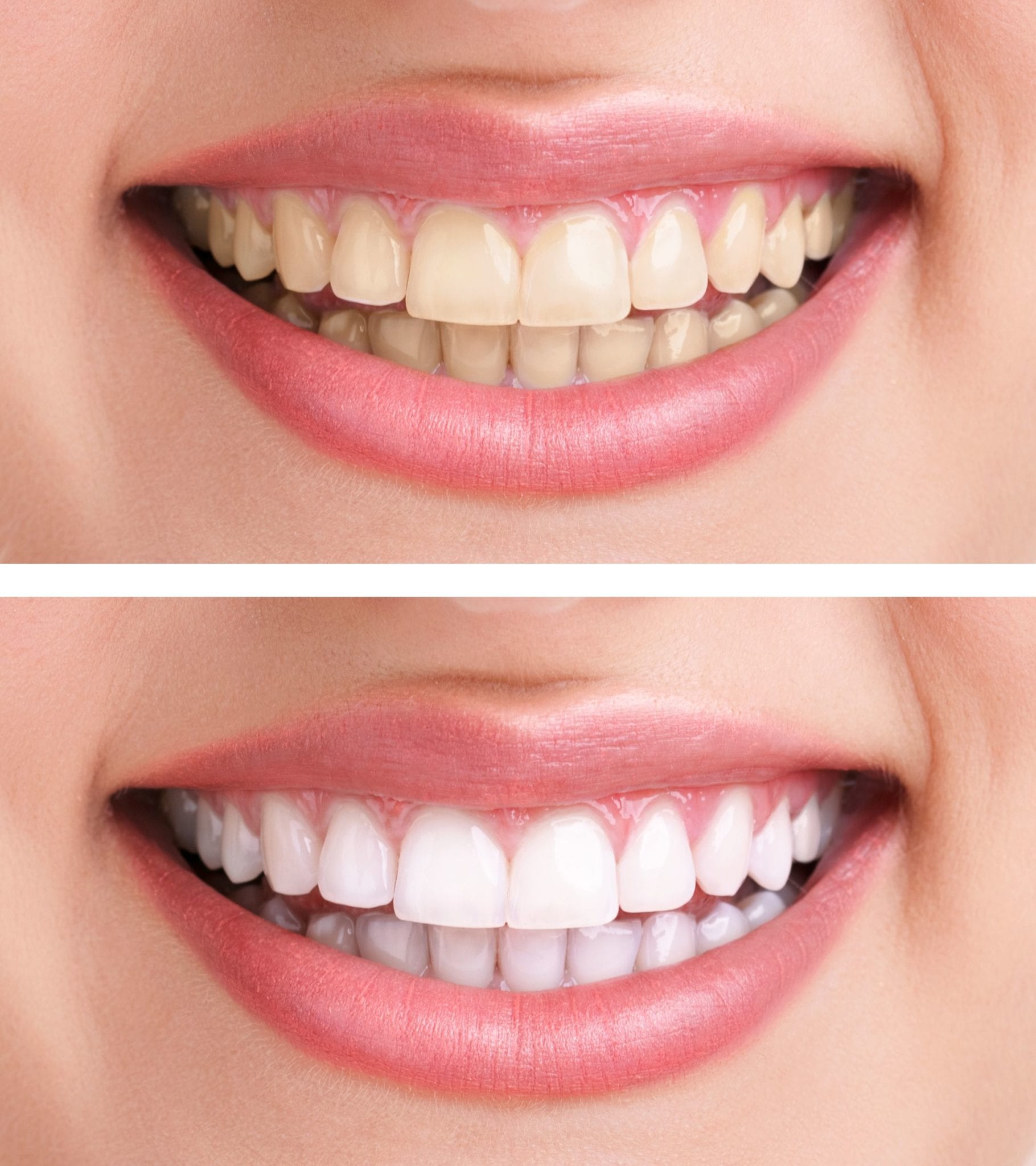 Before and After Teeth Whitening Photo of Model 2