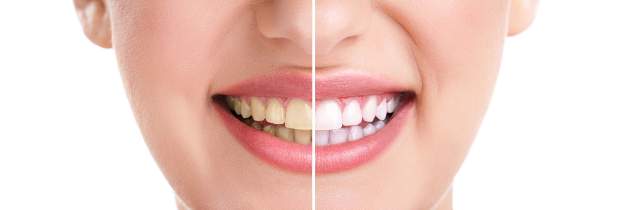 Before and After Teeth Whitening Photo of Model