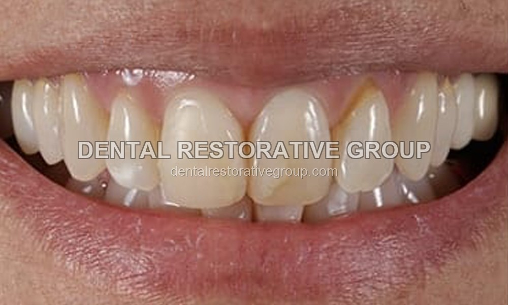 Veneers before treatment