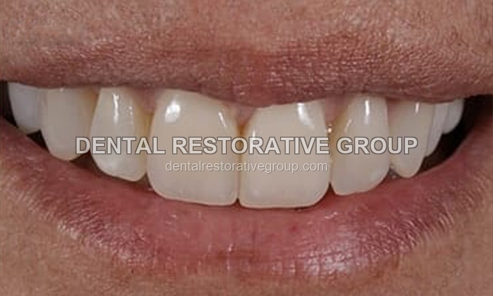 Veneers after treatment