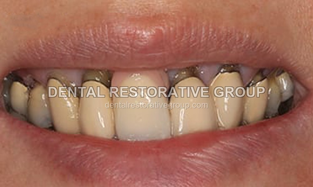 Full Mouth Reconstruction before treatment