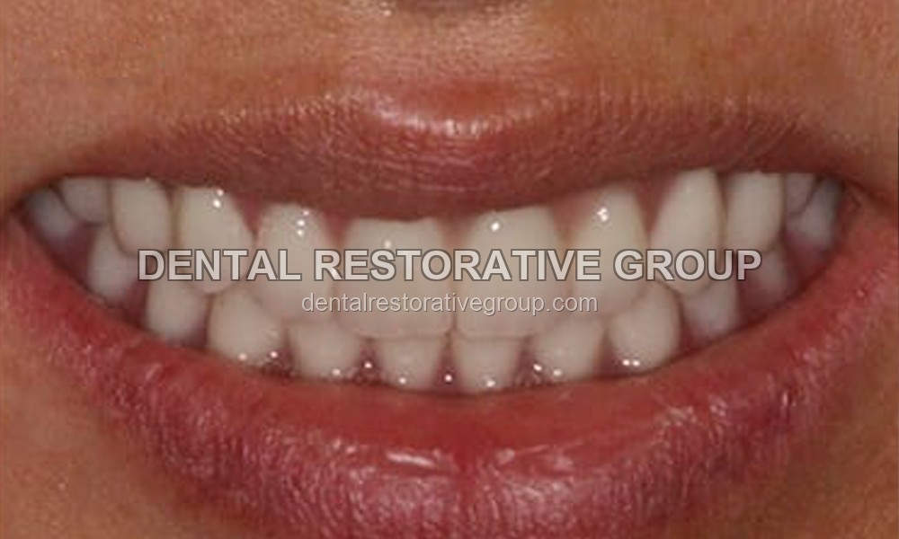 Full Mouth Reconstruction after treatment