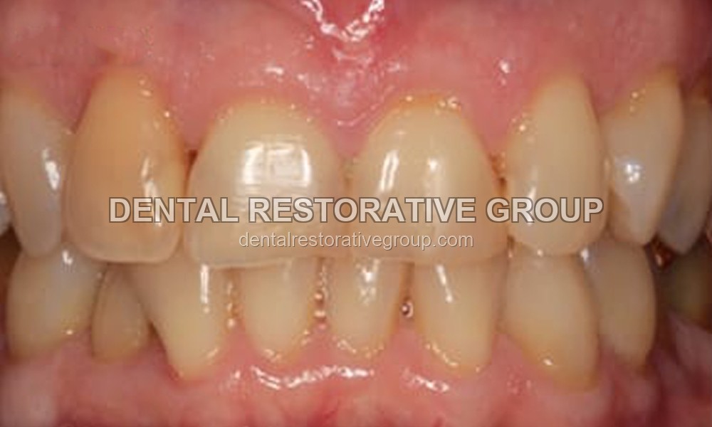 Dental Crowns before treatment