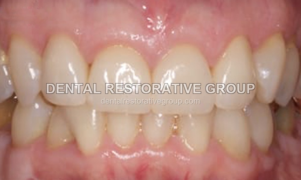 Dental Crowns after treatment