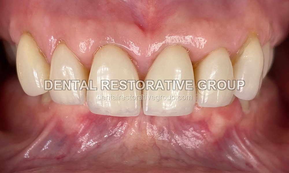All-on-Four before treatment