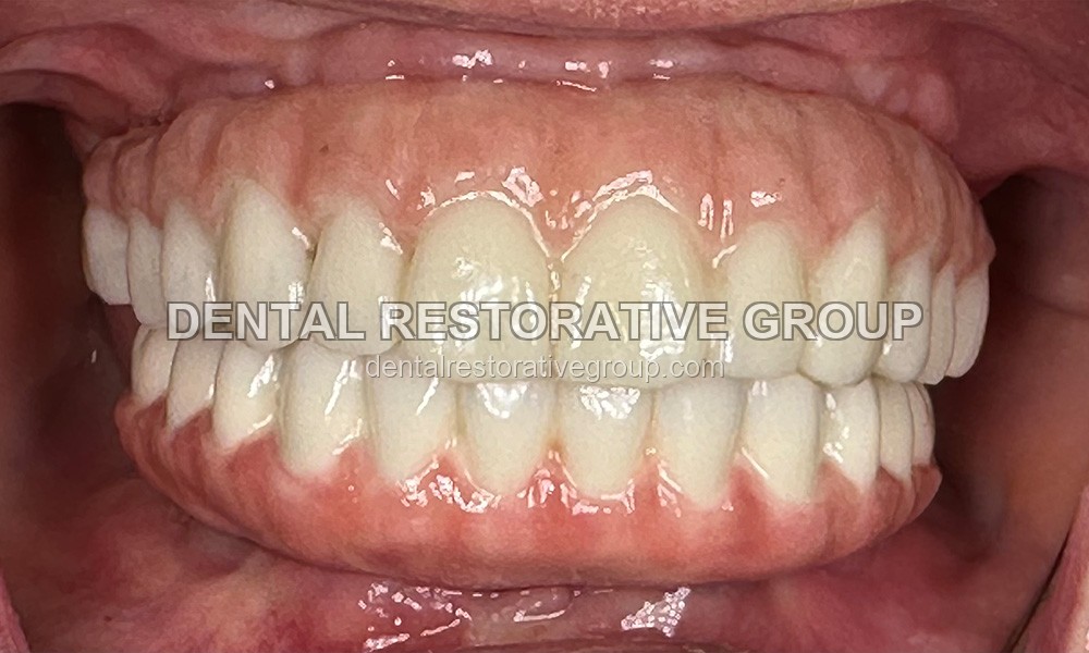 All-on-Four after treatment