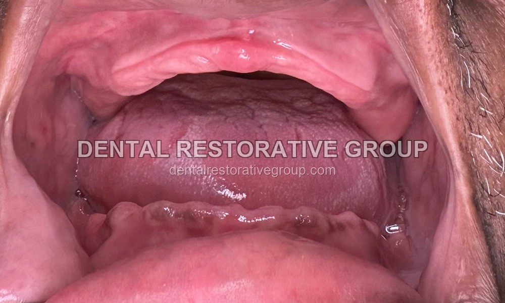 Upper Full Denture, Lower All-on-Four before treatment