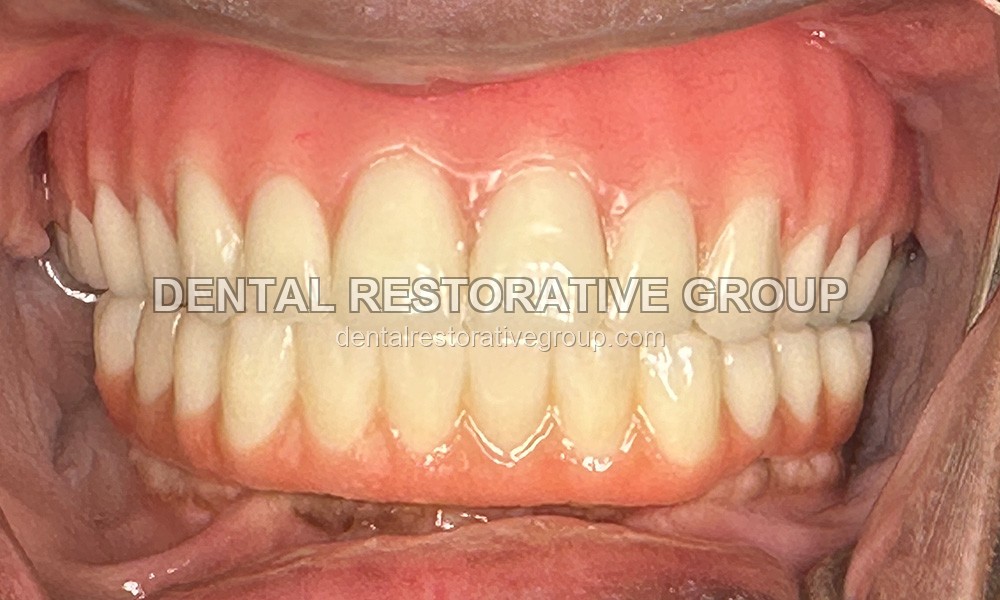 Upper Full Denture, Lower All-on-Four after treatment