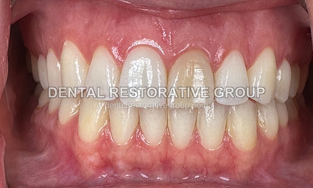 Highly Challenging Esthetic Case before treatment