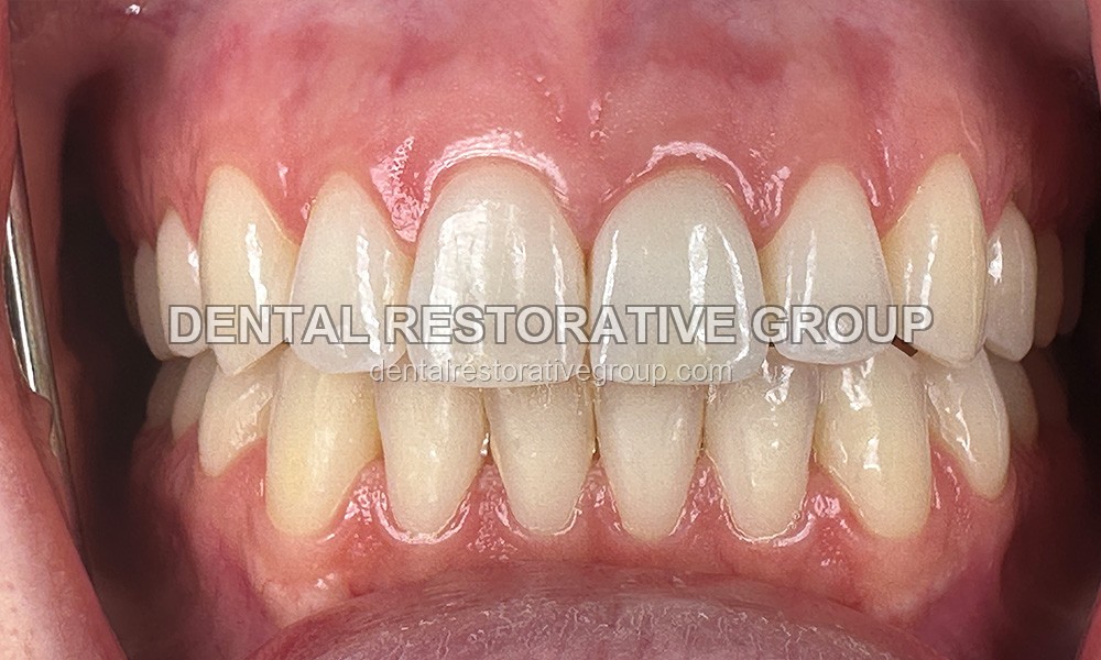 Highly Challenging Esthetic Case after treatment