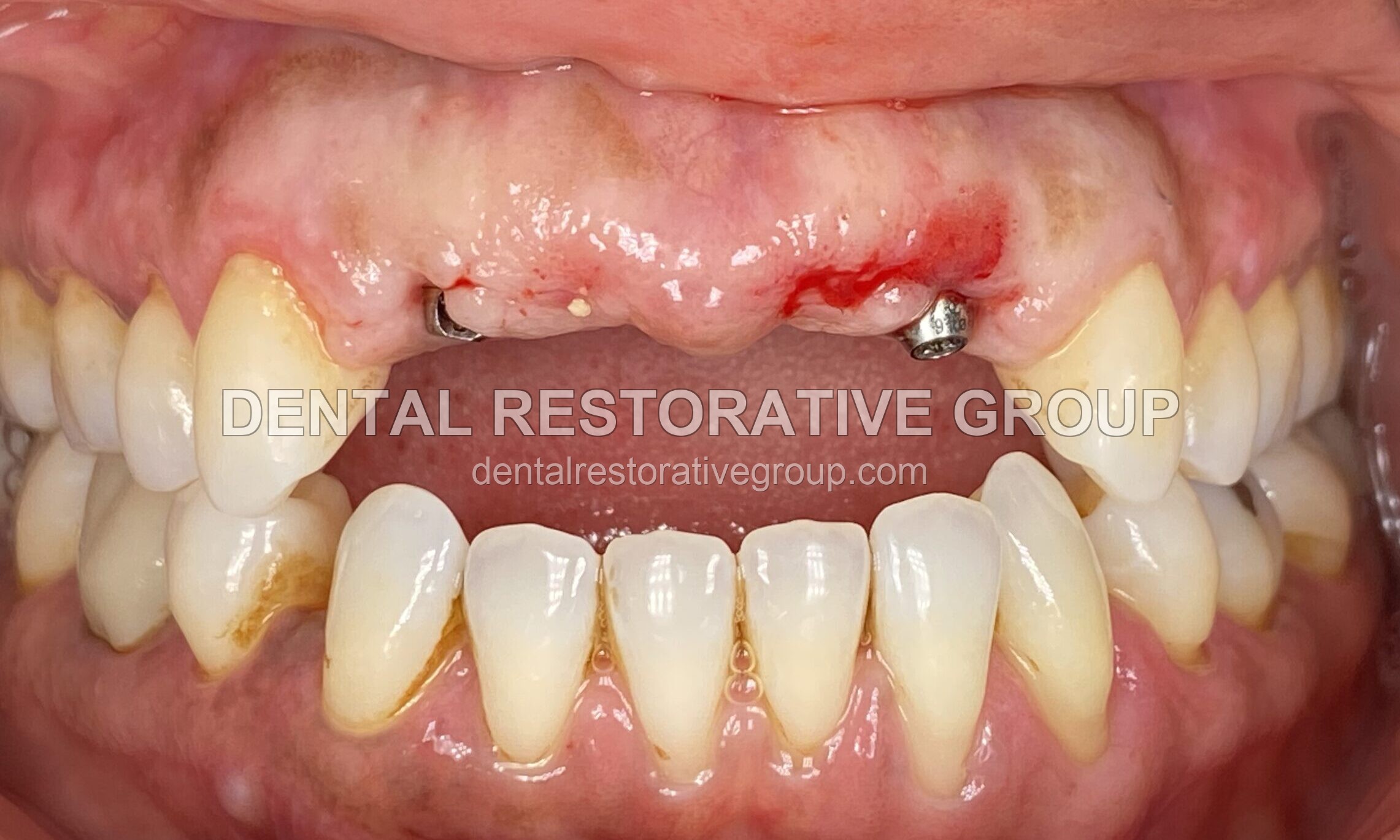 Dental Implant before treatment