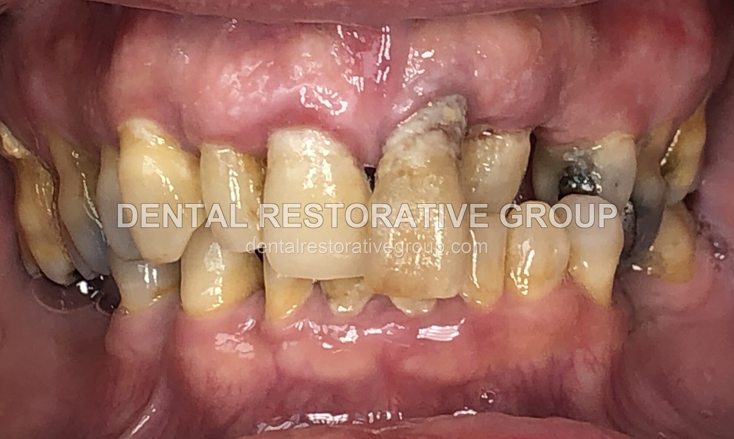 Oral Surgery before treatment