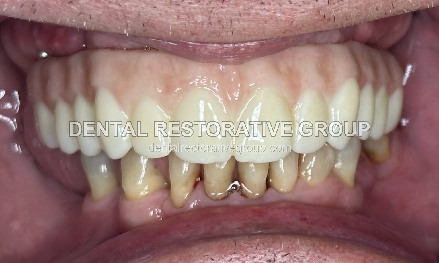 Oral Surgery after treatment