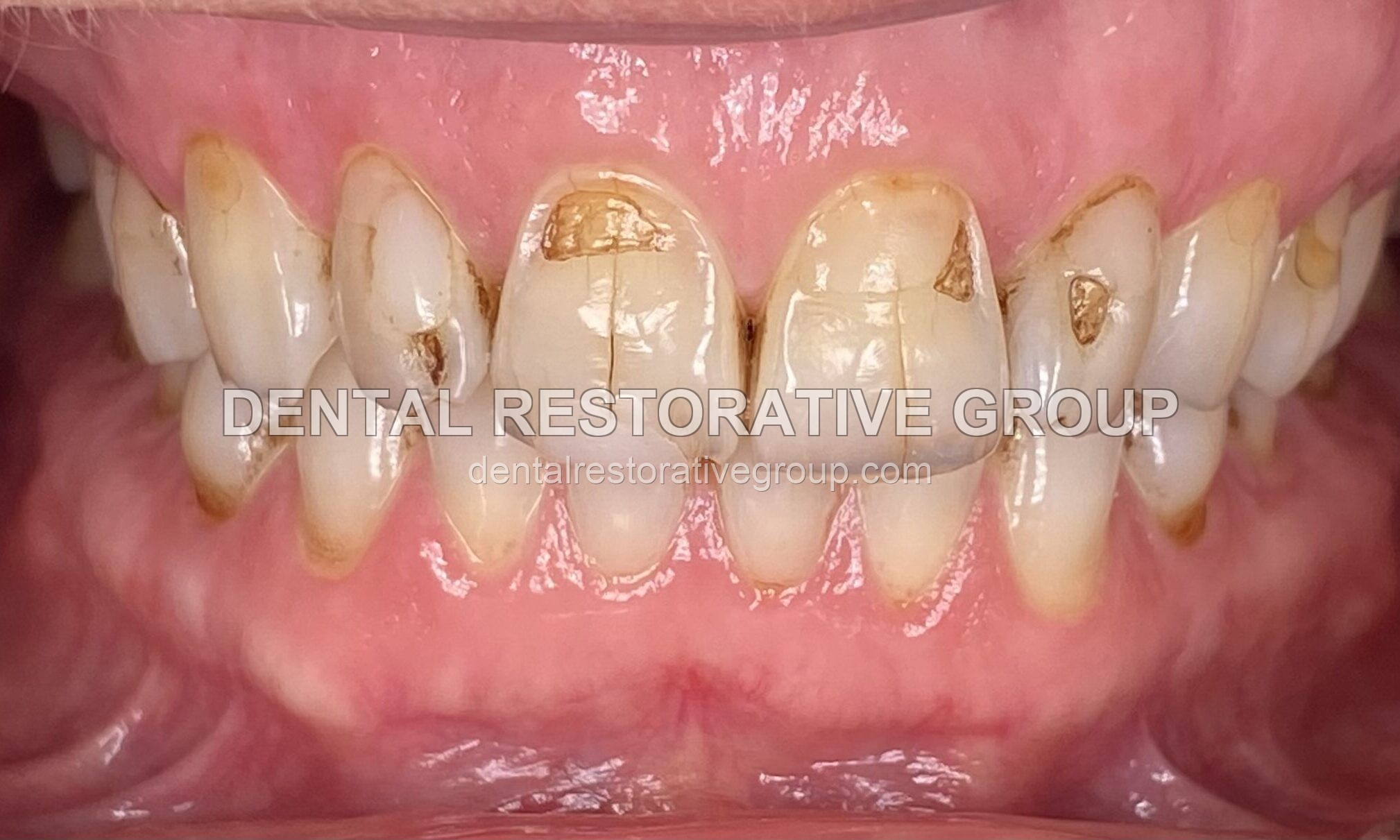 Cosmetic Dentistry before treatment