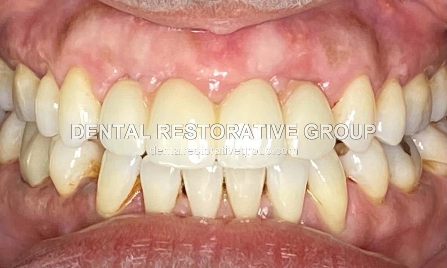 Dental Implant after treatment