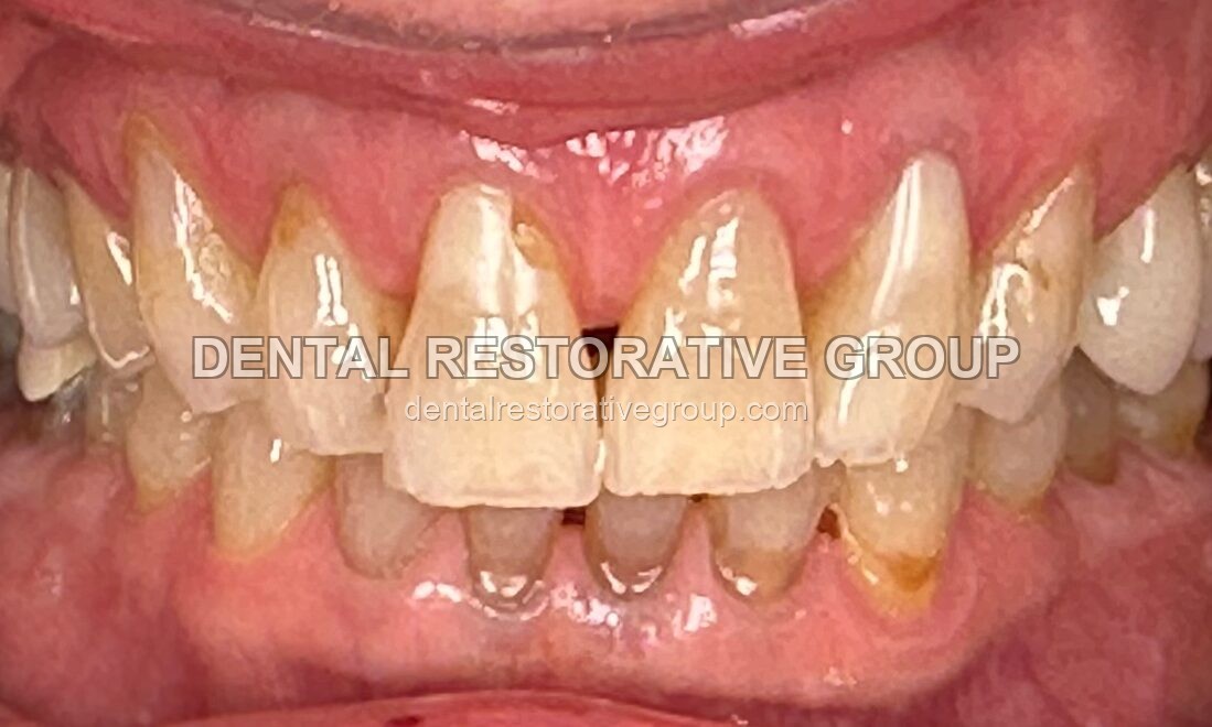 Full Mouth Case with Esthetic Crowns before treatment