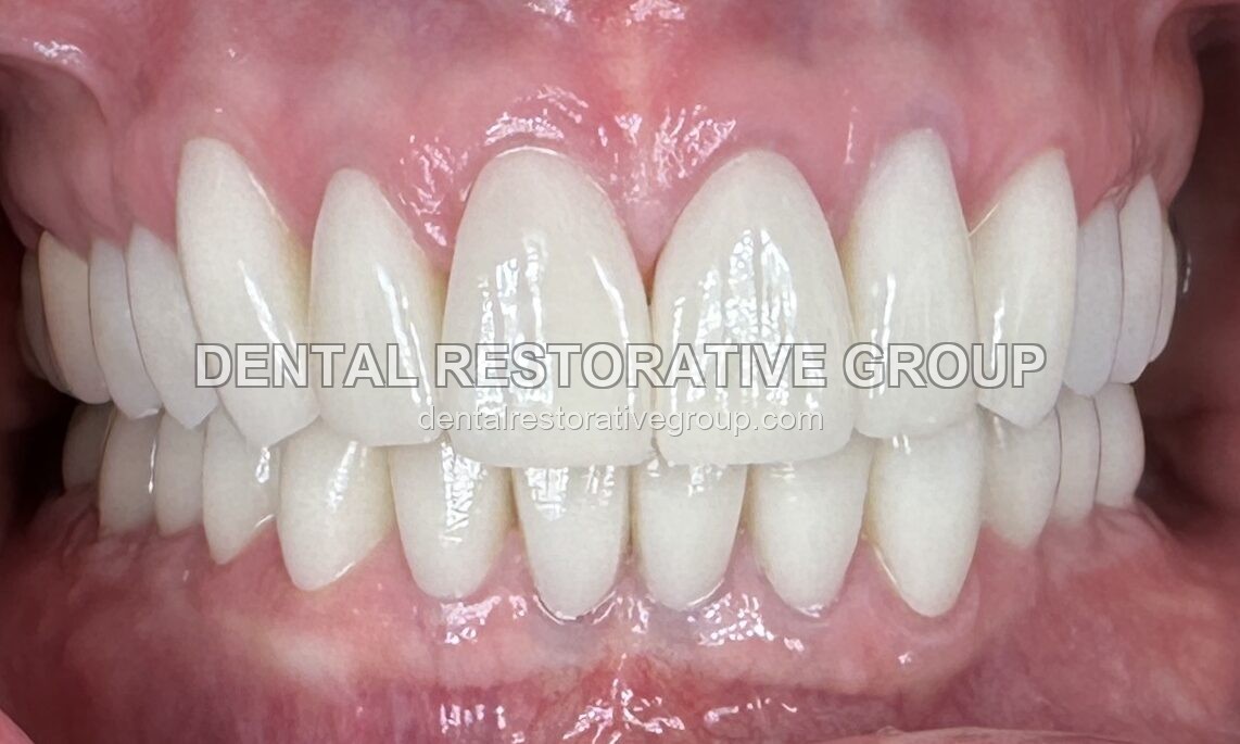 Full Mouth Case with Esthetic Crowns after treatment