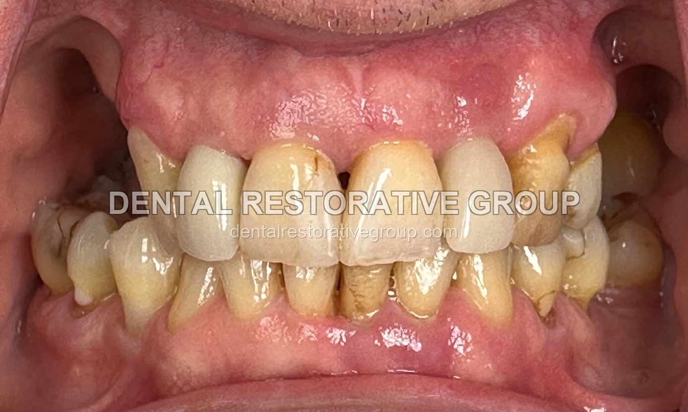 Upper and Lower All-on-Four before treatment