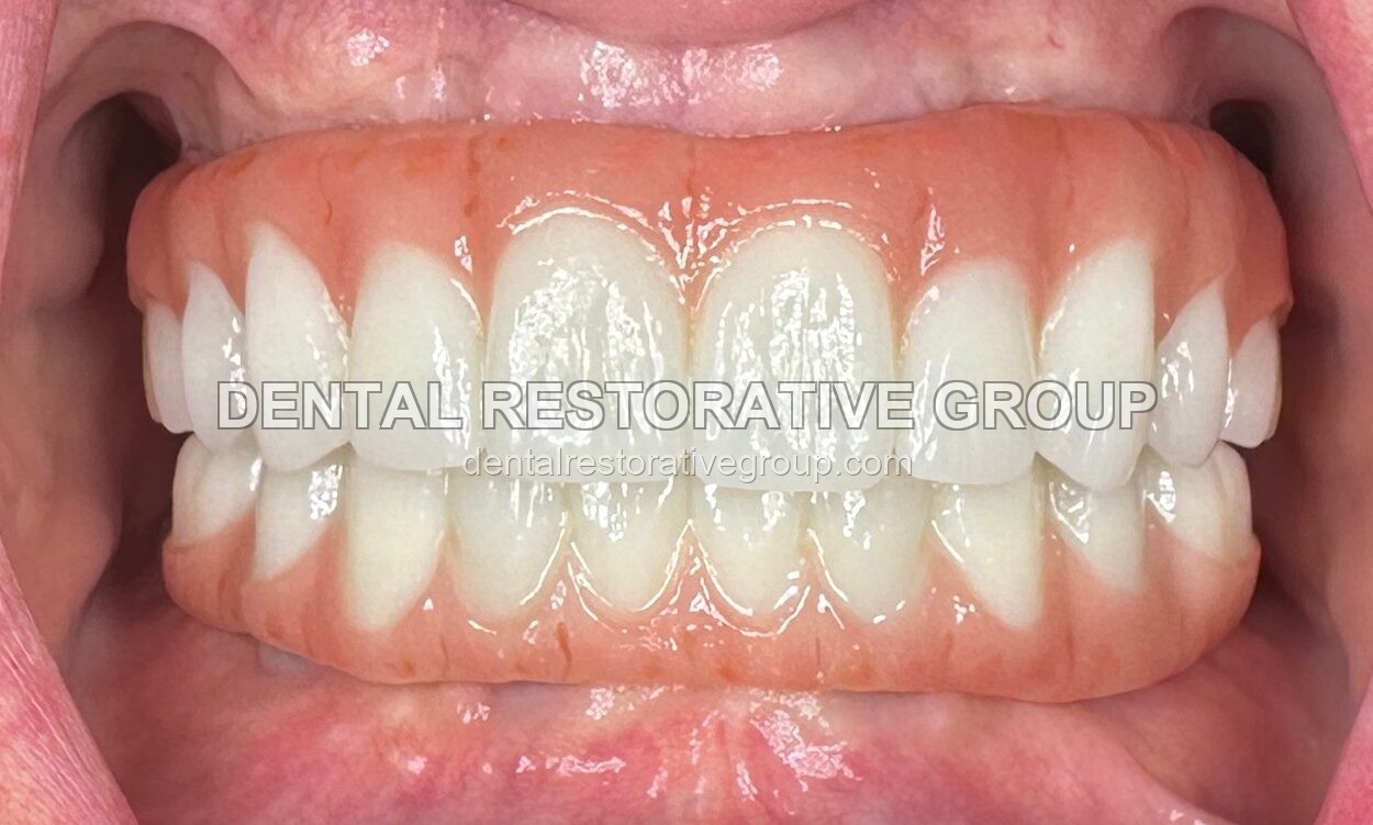 Upper and Lower All-on-Four after treatment