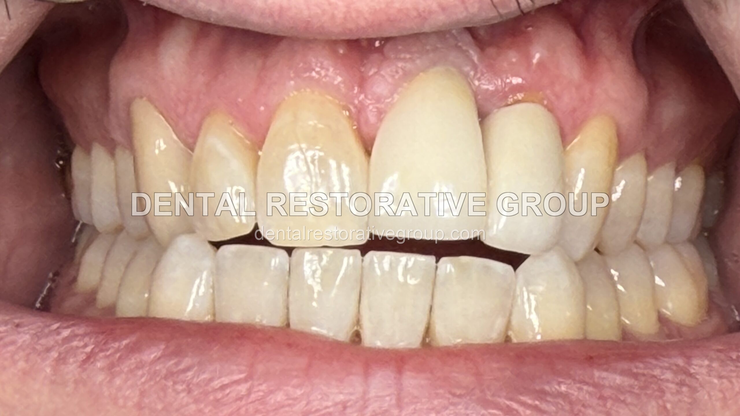 Before and After before treatment