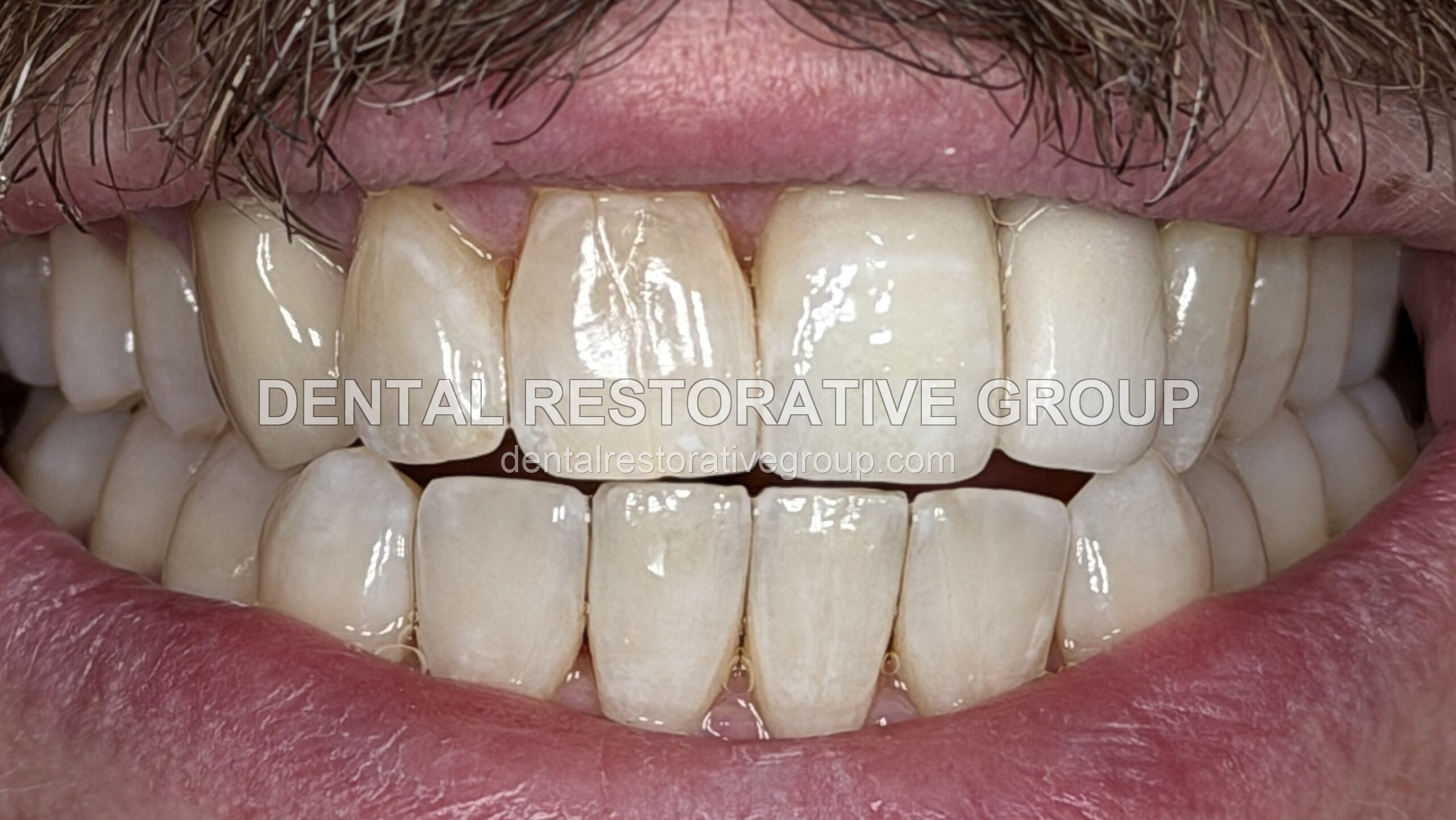 Before and After after treatment