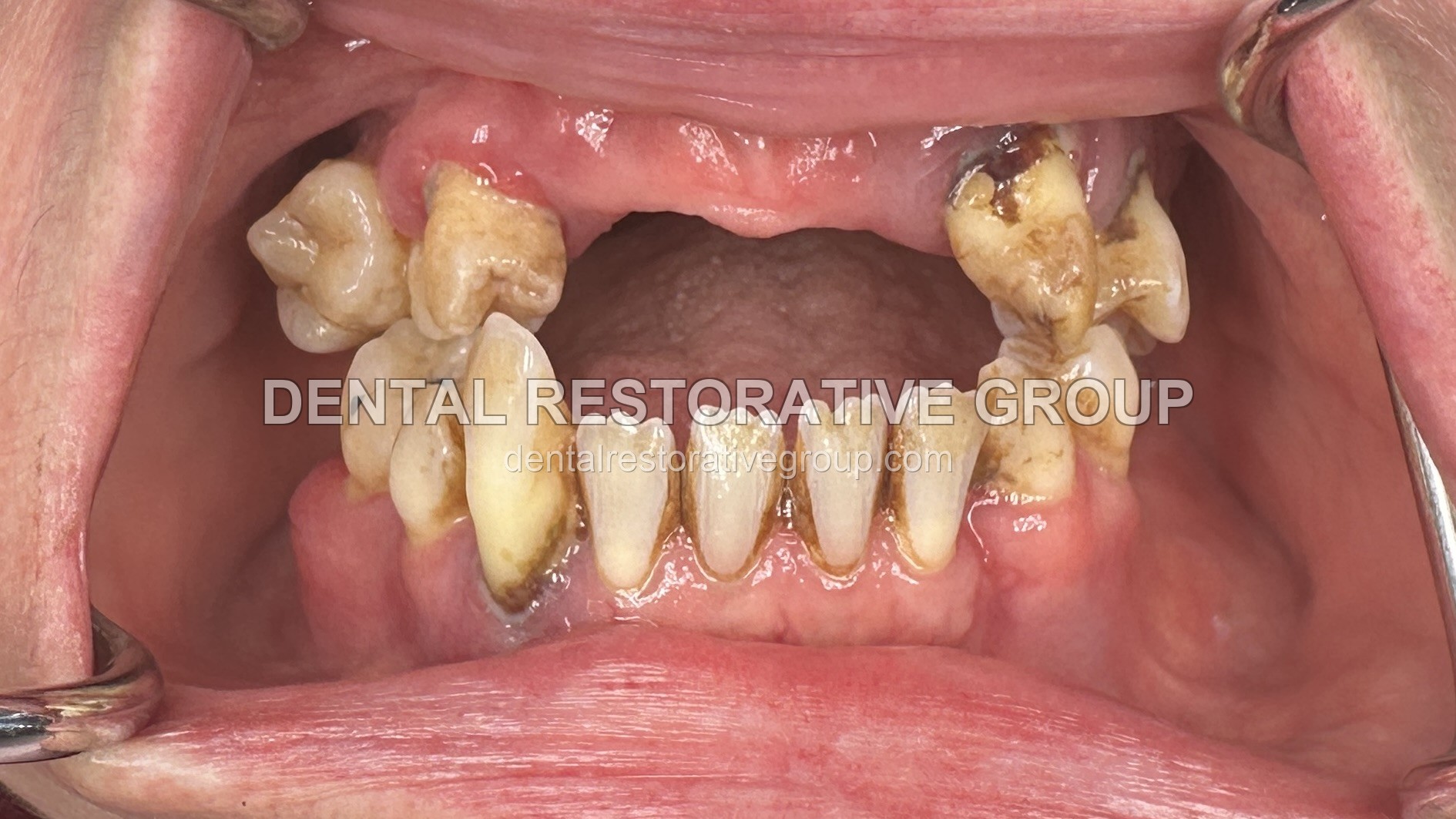 Full Mouth Rehabilitation before treatment