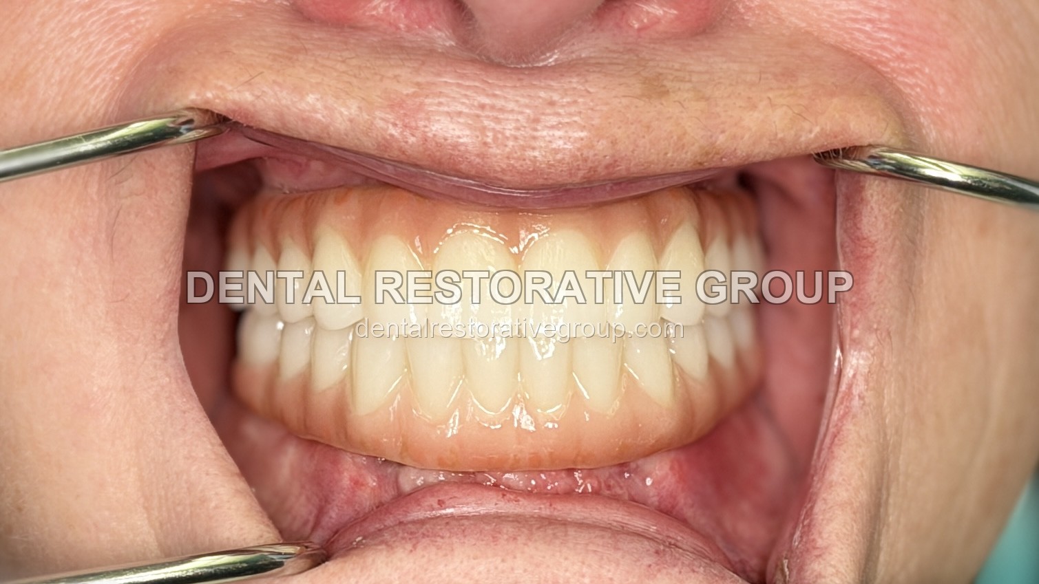 Full Mouth Rehabilitation after treatment