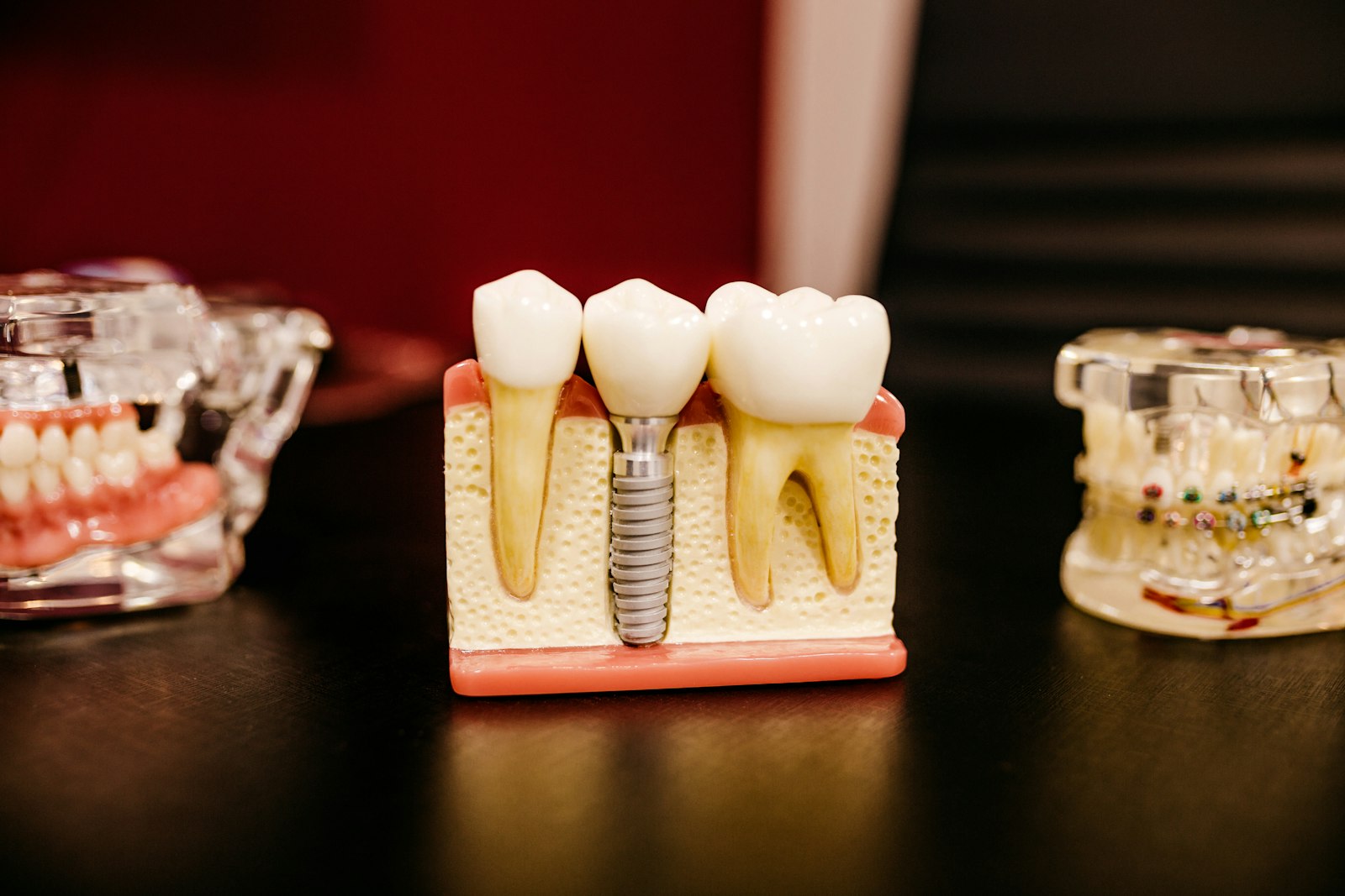 Dental implant model used to plan implant and prosthodontic treatment