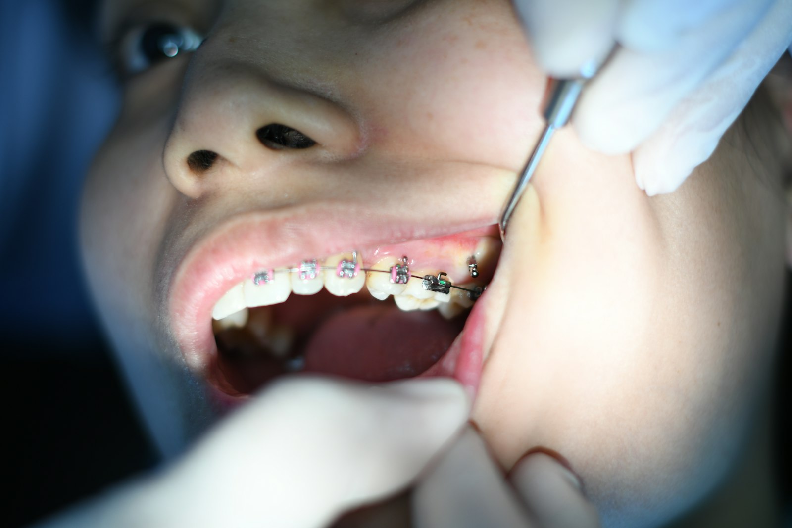Person with braces during orthodontic treatment for a missing lateral incisor