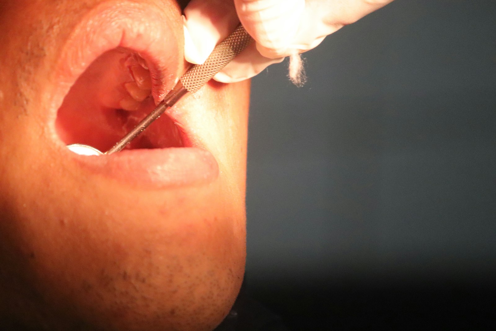 Dentist examining a broken tooth to determine what actually failed in Belmont MA