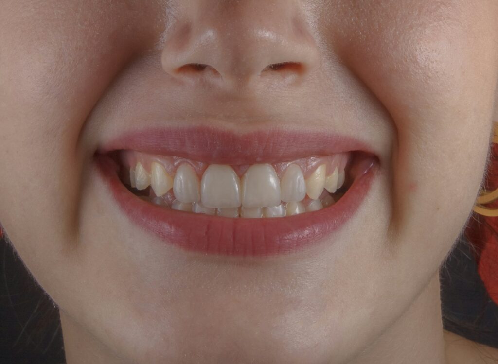 Close-up of teeth and gums, where recession exposes the tooth root in Belmont MA