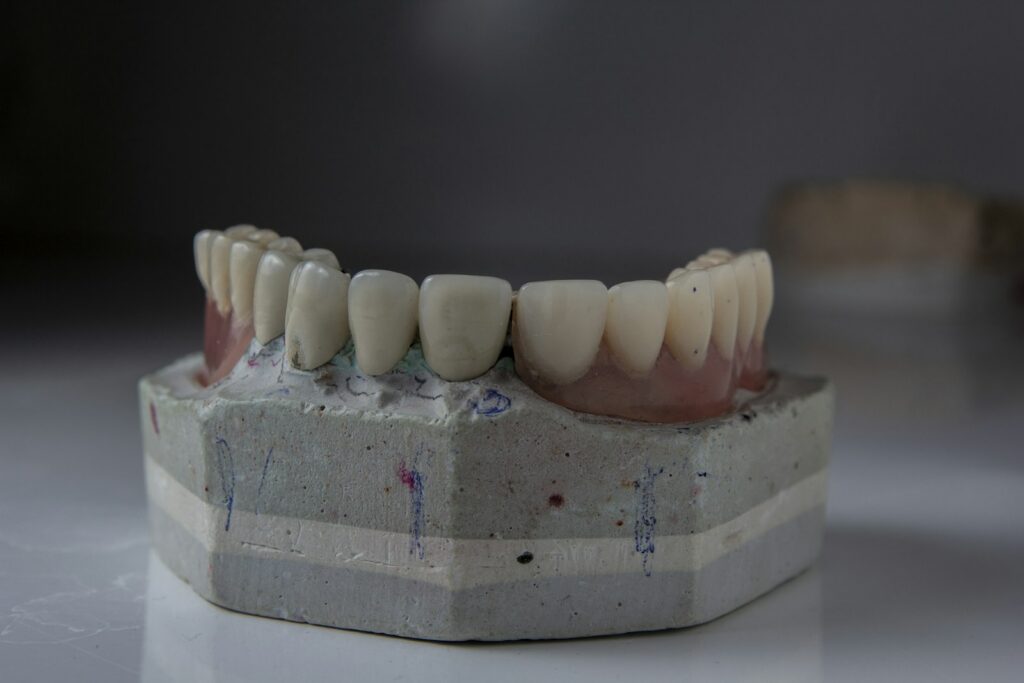 Dental implant model illustrating timing options for placement in Belmont MA