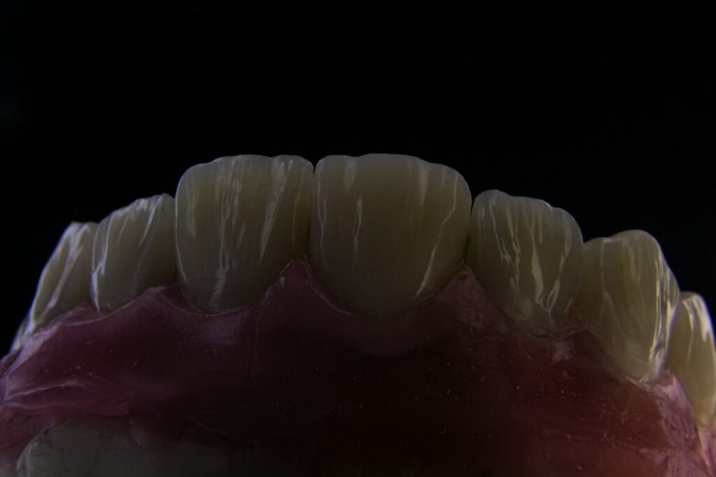 Dental model of a molar used to weigh replacing a missing back tooth in Belmont MA