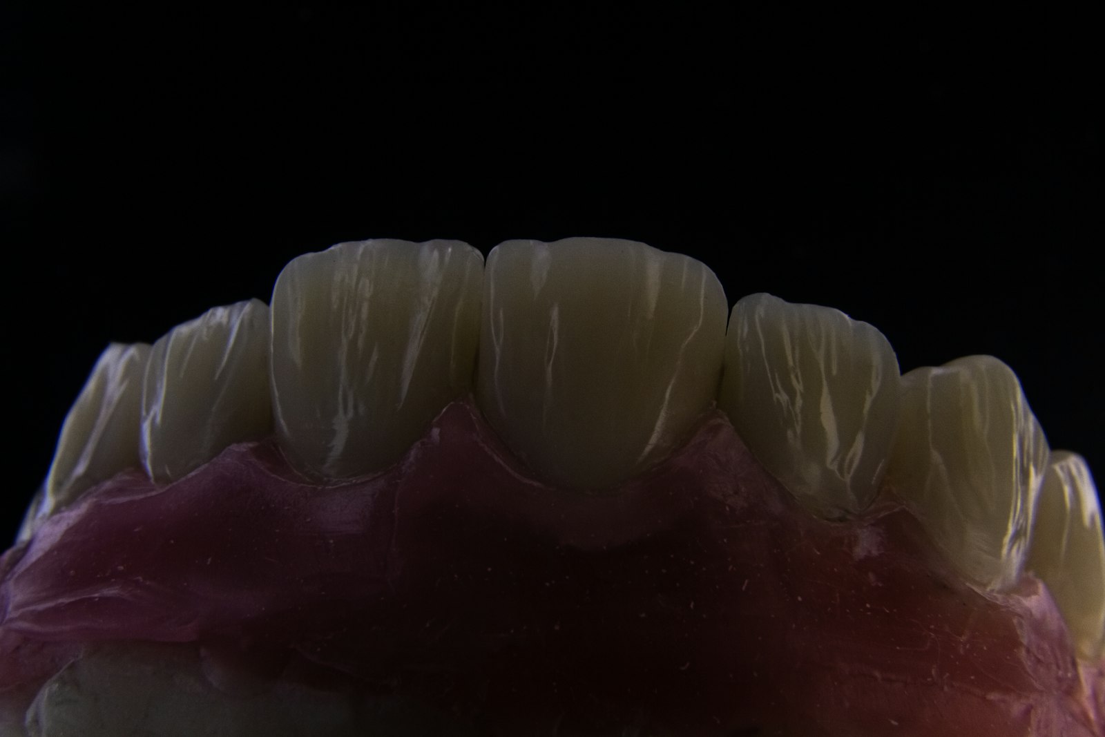 Dental model of a molar used to weigh replacing a missing back tooth in Belmont MA