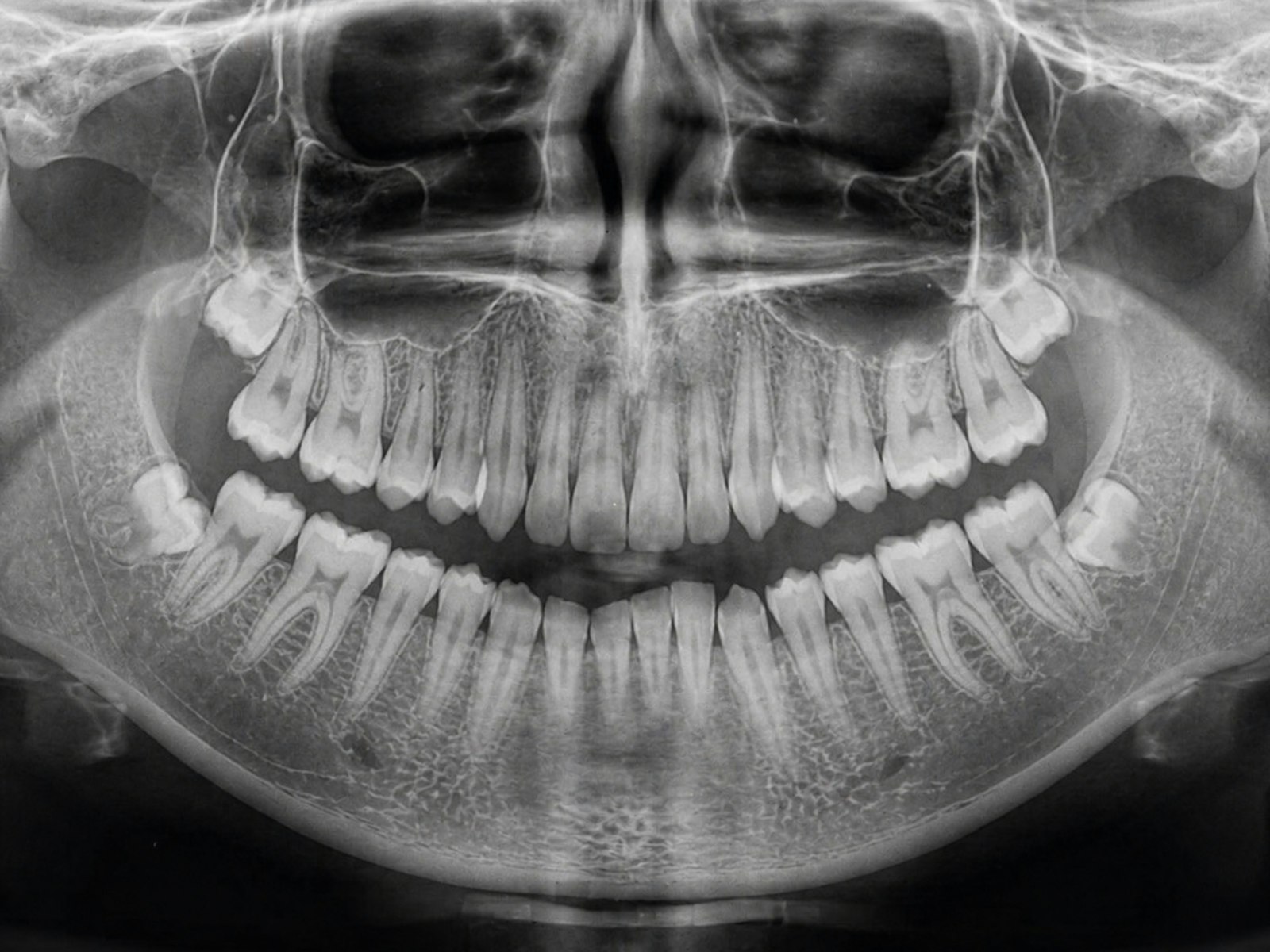 Panoramic dental X-ray used to evaluate a missing molar in Belmont MA