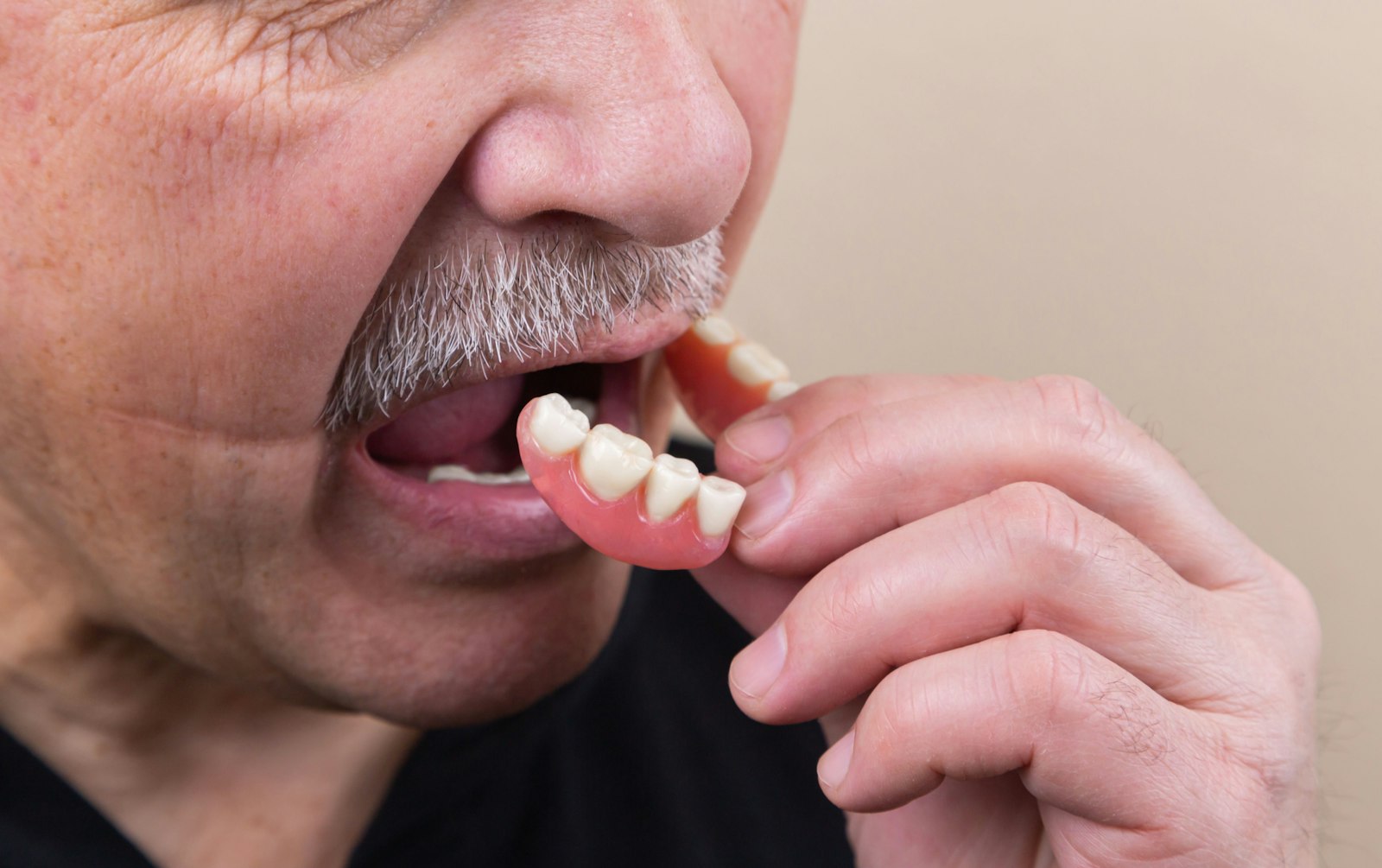 A removable implant overdenture that the patient takes out to clean