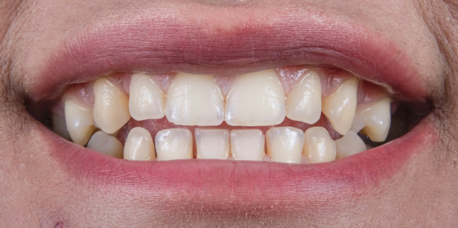 Biting into an apple with well-maintained dental restorations