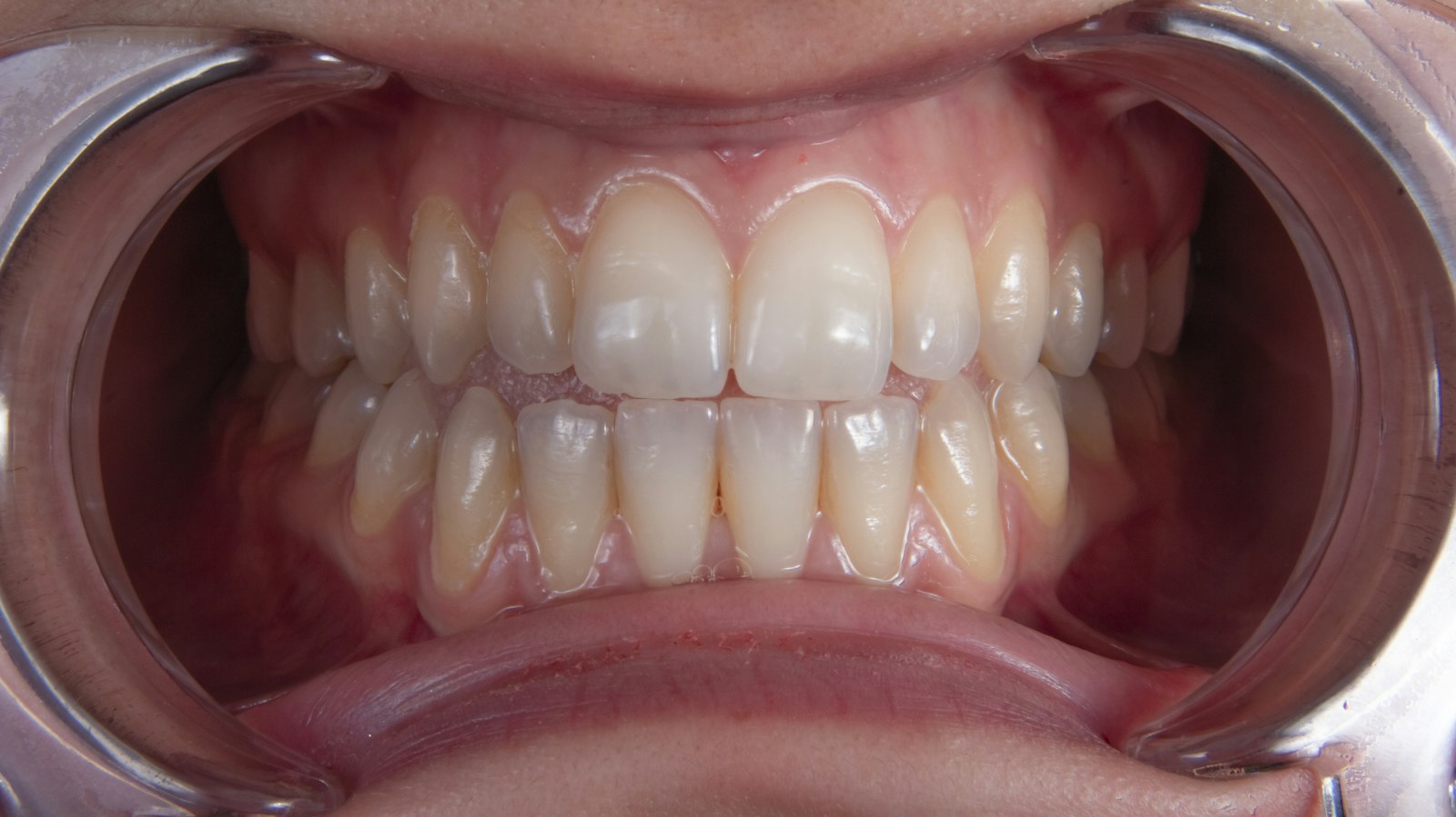 A healthy smile maintained with good restoration care in Belmont MA