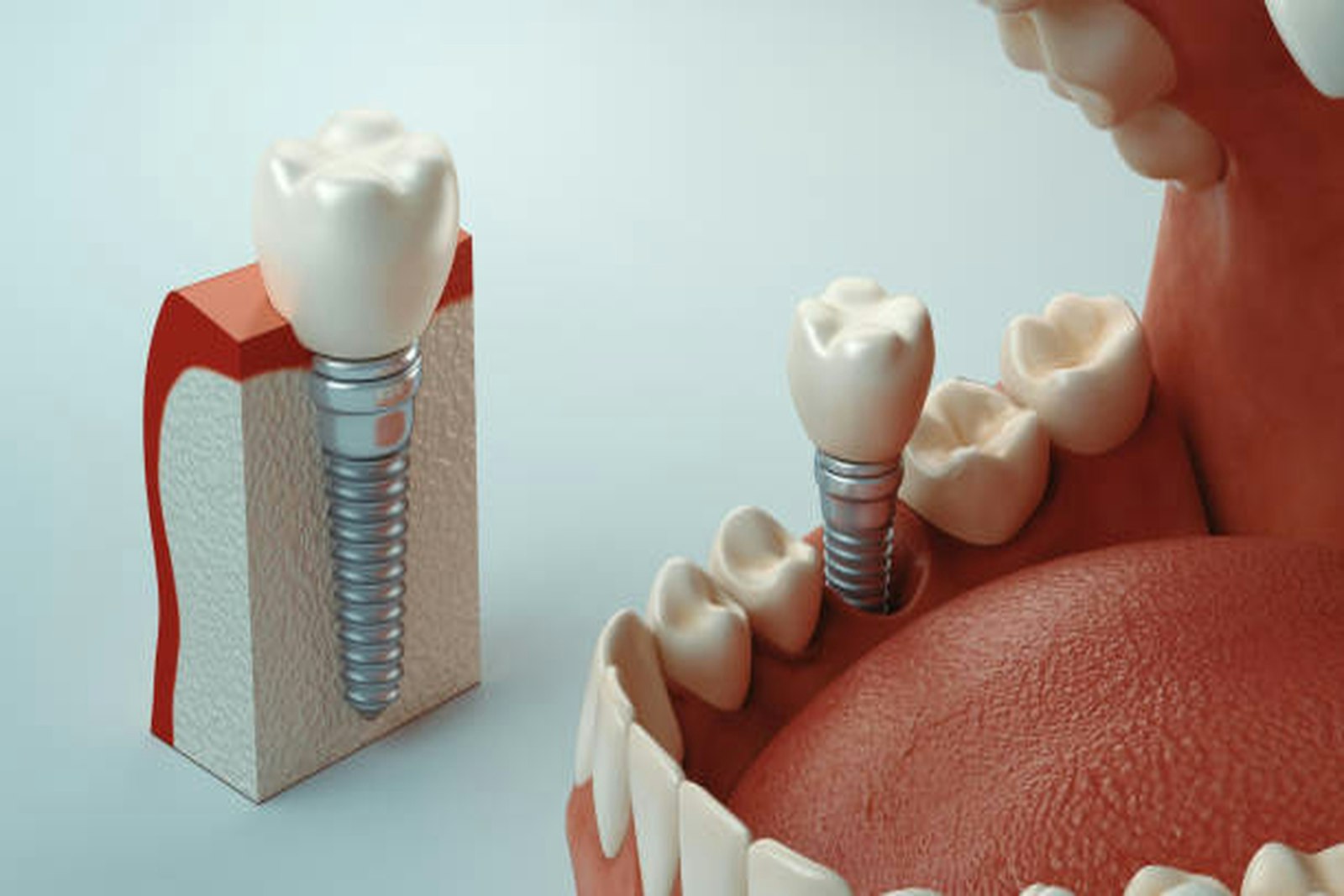 Dental implants that anchor a snap-in denture in Cambridge MA