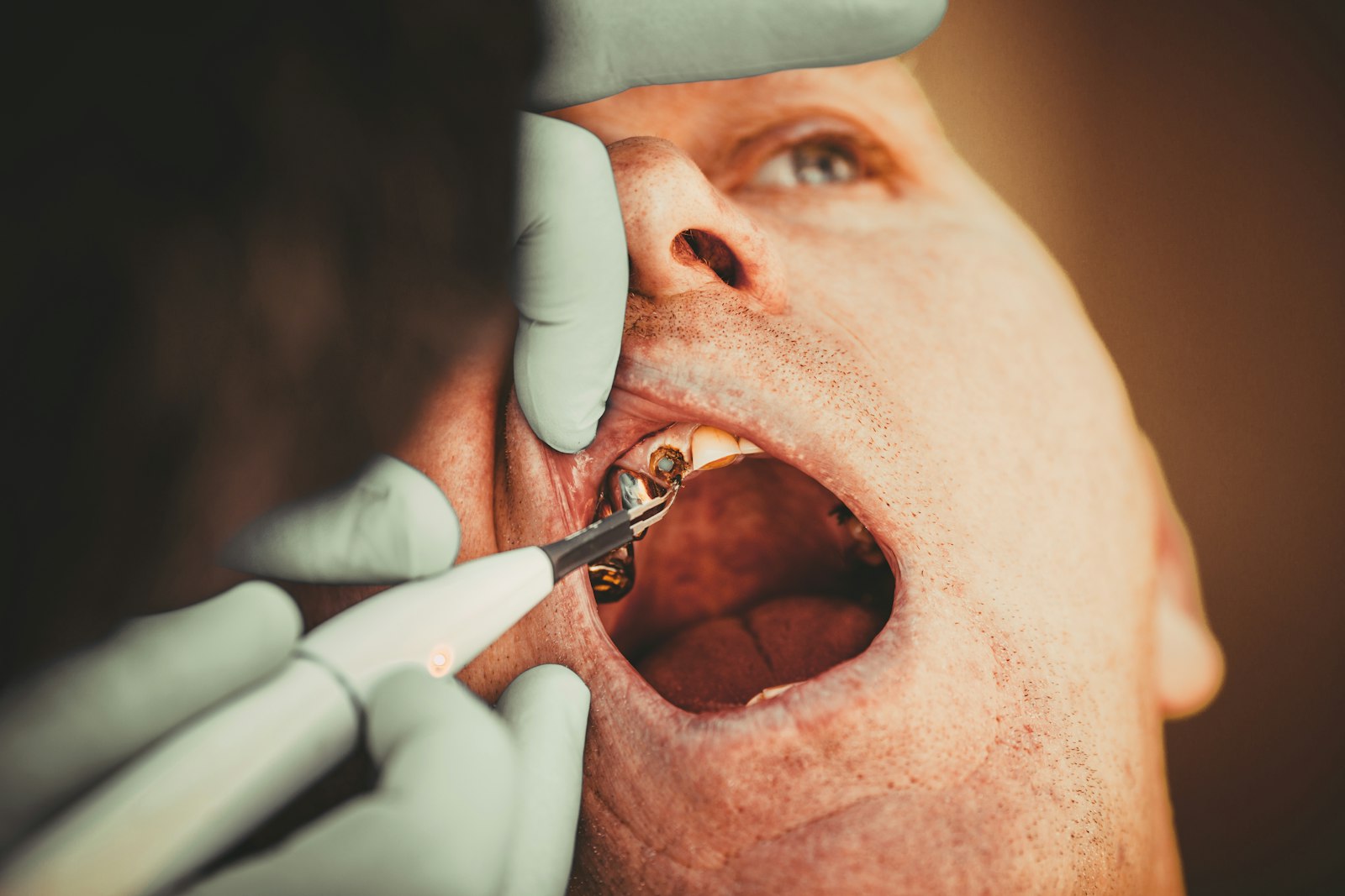 Dentist placing a custom restoration on a tooth in Cambridge MA
