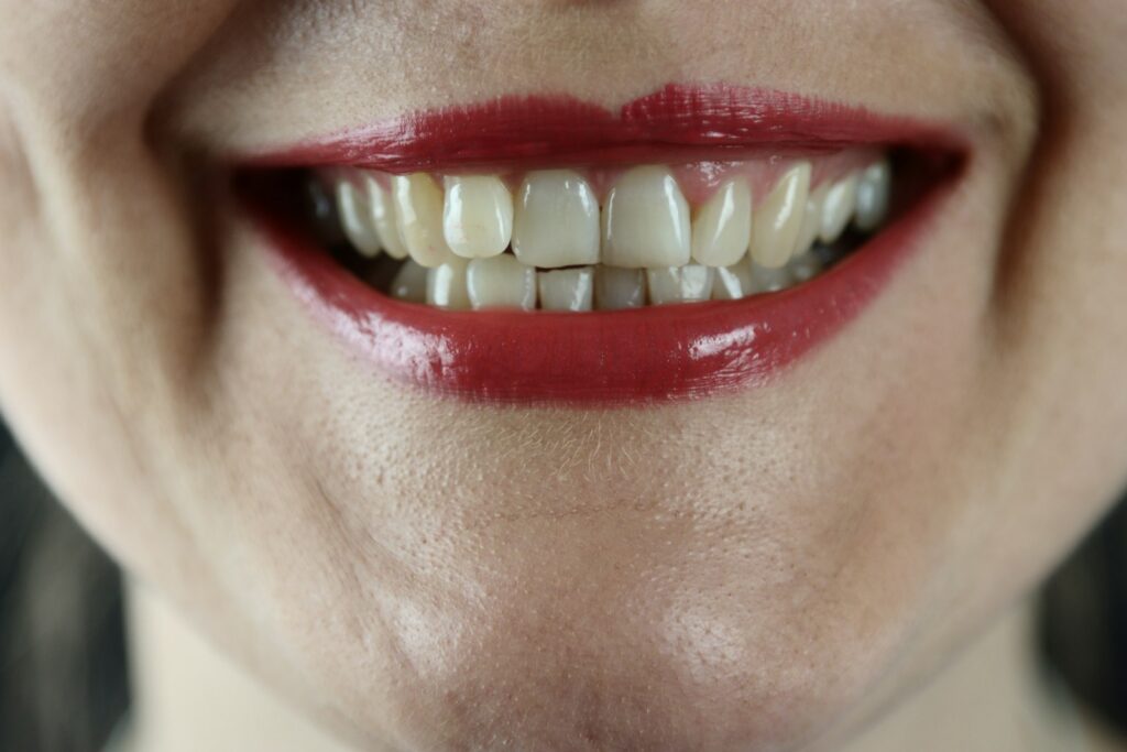 Close-up of teeth showing the kind of wear that develops over time in Belmont MA