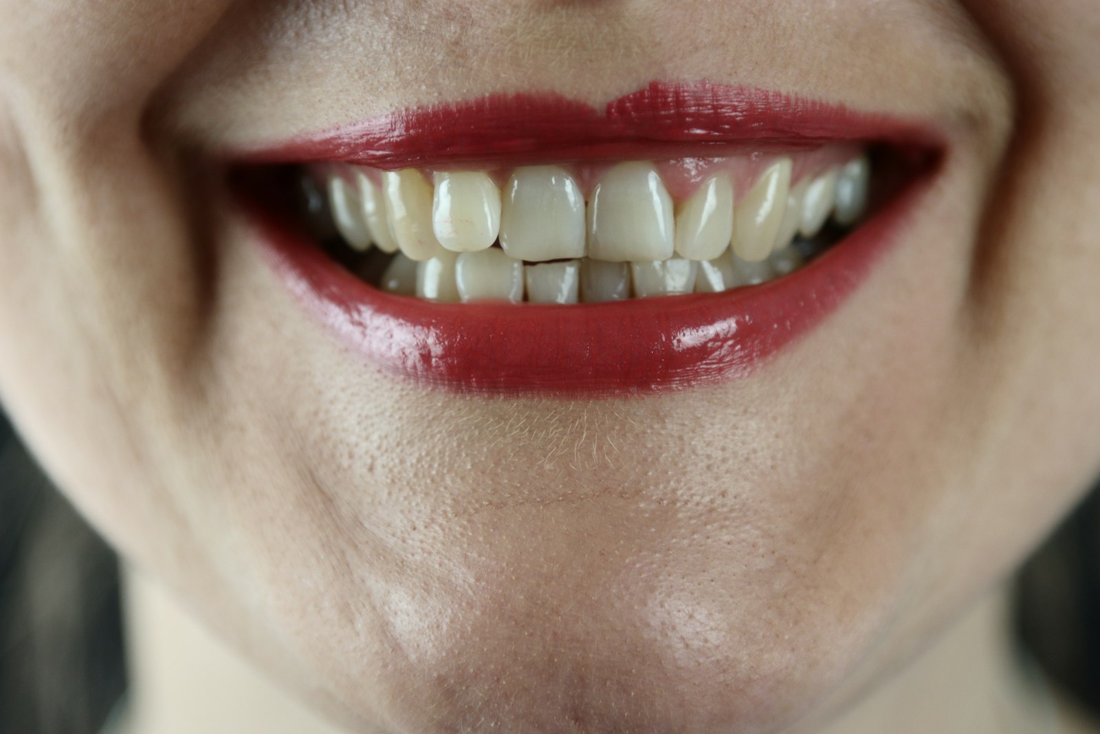 Close-up of teeth showing the kind of wear that develops over time in Belmont MA
