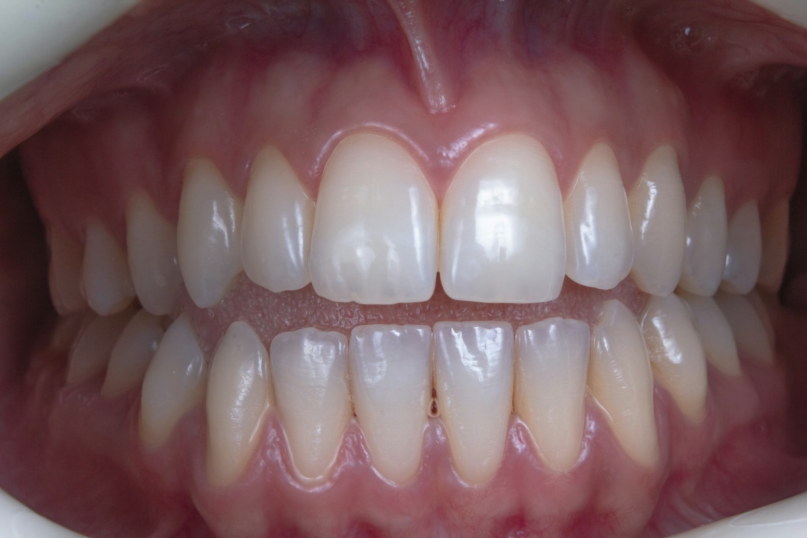 Close-up of teeth showing black triangles near the gumline in Belmont MA