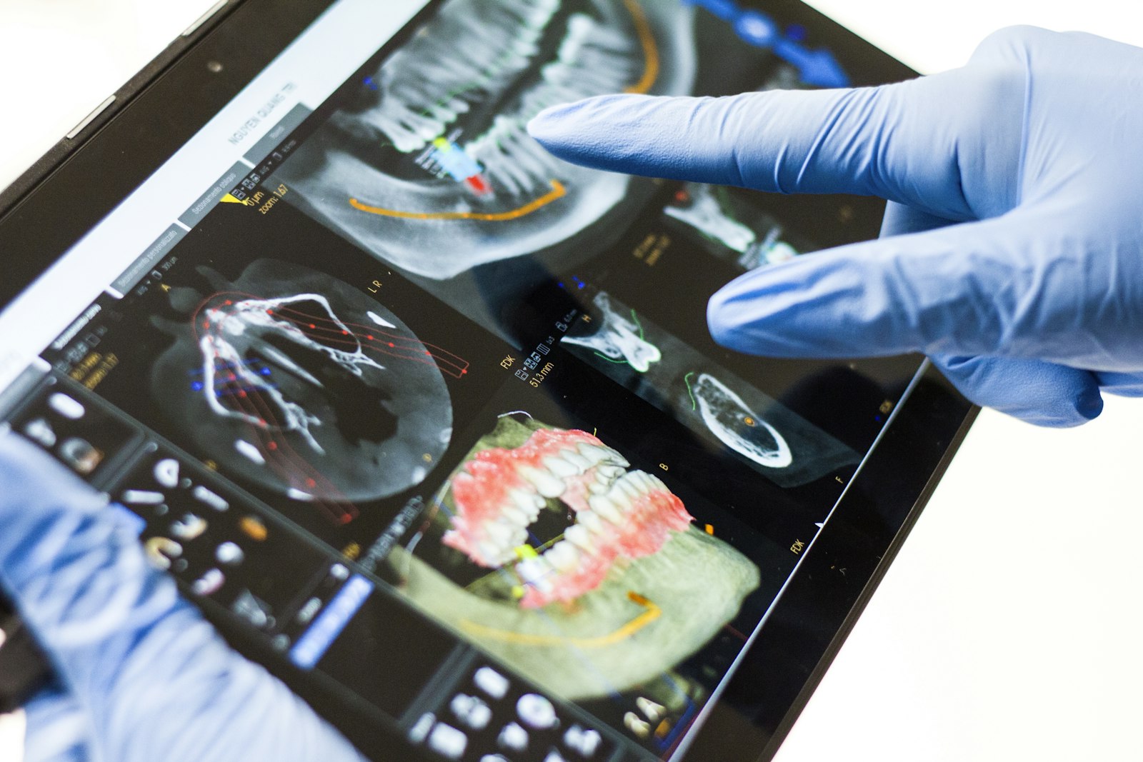 3D imaging used to plan bone grafting for a dental implant in Belmont MA