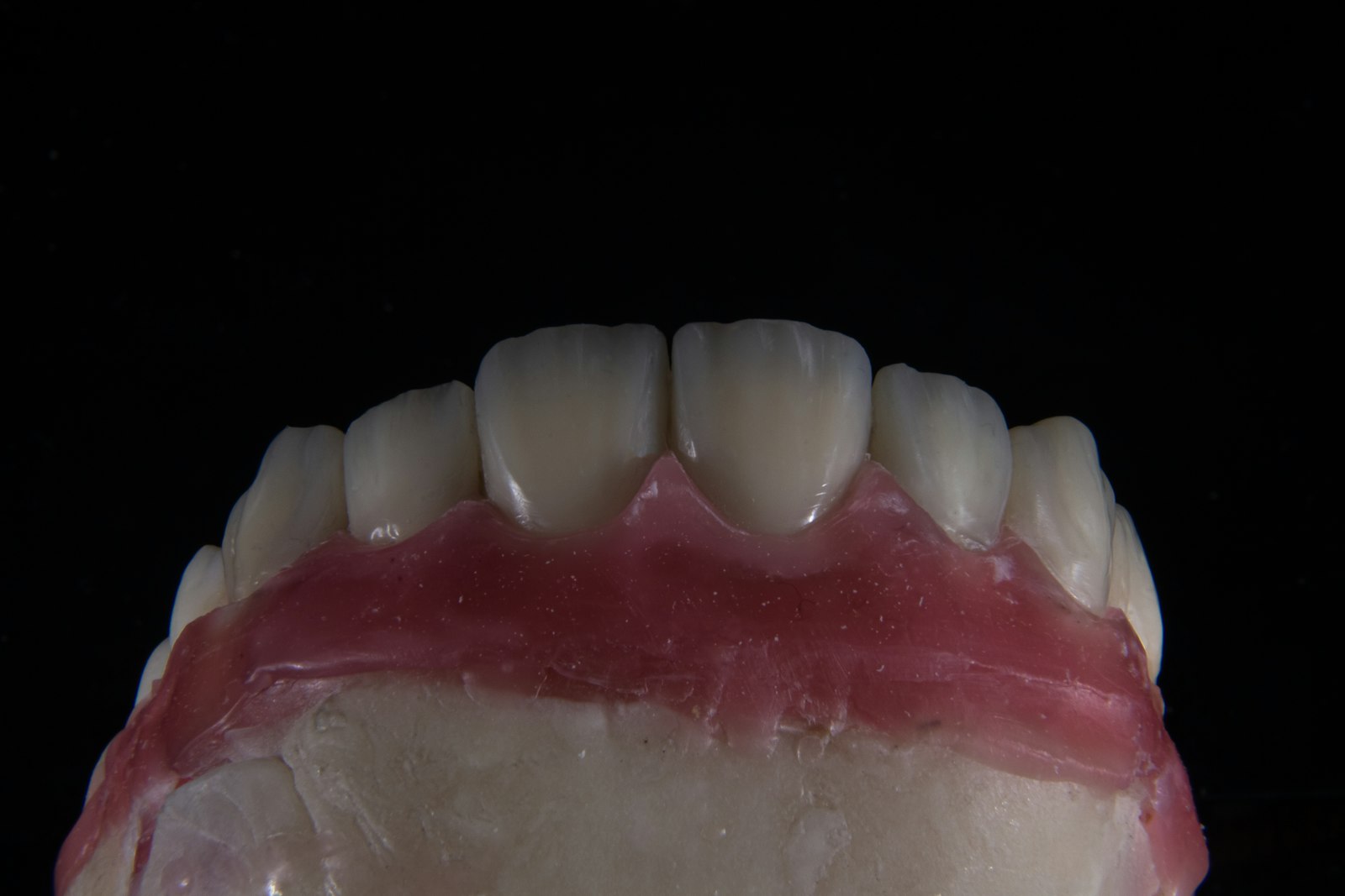 A dental crown being checked for fit in Cambridge MA